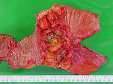 写真:進行胃癌の切除標本